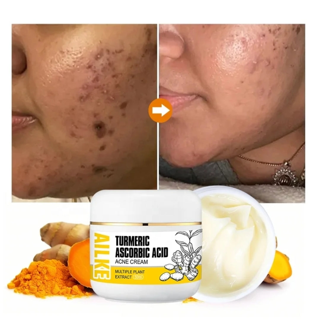 Turmeric Acne Cream